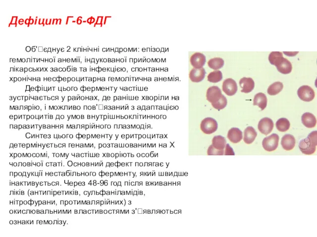 Дефіцит Г-6-ФДГ Об'єднує 2 клінічні синдроми: епізоди гемолітичної анемії, індукованої