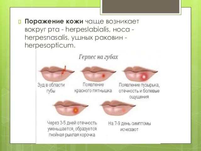 Поражение кожи чаще возникает вокруг рта - herpeslabialis, носа - herpesnasalis, ушных раковин - herpesoptiсum.
