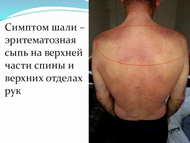 Симптом шали – эритематозная сыпь на верхней части спины и верхних отделах рук