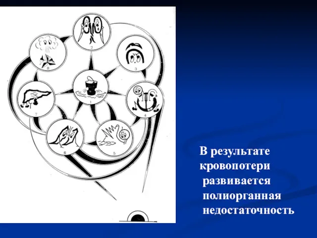 В результате кровопотери развивается полиорганная недостаточность