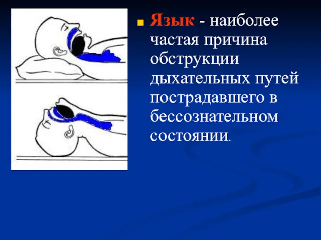 Язык - наиболее частая причина обструкции дыхательных путей пострадавшего в бессознательном состоянии.