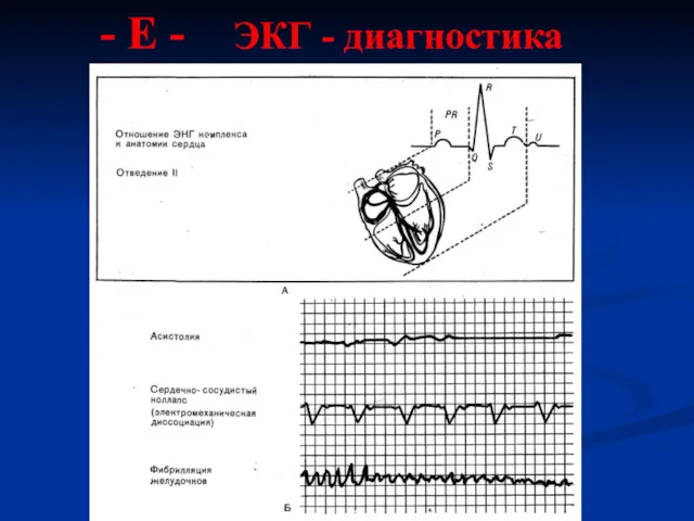 - Е - ЭКГ - диагностика