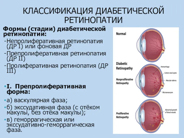 КЛАССИФИКАЦИЯ ДИАБЕТИЧЕСКОЙ РЕТИНОПАТИИ Формы (стадии) диабетической ретинопатии: Непролиферативная ретинопатия (ДР