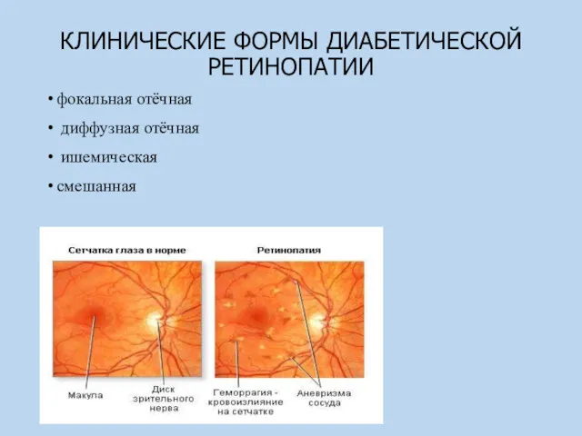 КЛИНИЧЕСКИЕ ФОРМЫ ДИАБЕТИЧЕСКОЙ РЕТИНОПАТИИ фокальная отёчная диффузная отёчная ишемическая смешанная