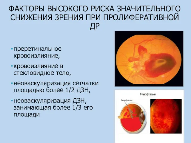 ФАКТОРЫ ВЫСОКОГО РИСКА ЗНАЧИТЕЛЬНОГО СНИЖЕНИЯ ЗРЕНИЯ ПРИ ПРОЛИФЕРАТИВНОЙ ДР преретинальное