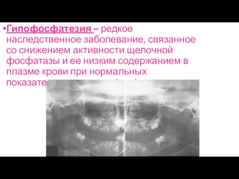 Гипофосфатезия – редкое наследственное заболевание, связанное со снижением активности щелочной