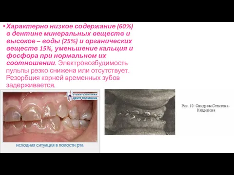 Характерно низкое содержание (60%) в дентине минеральных веществ и высокое