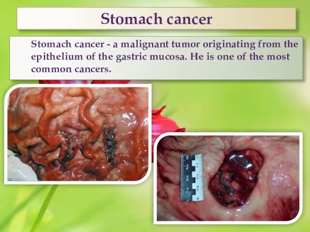 Stomach cancer Stomach cancer - a malignant tumor originating from the epithelium of