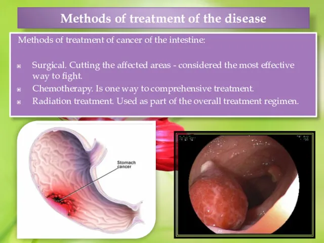 Methods of treatment of the disease Methods of treatment of cancer of the
