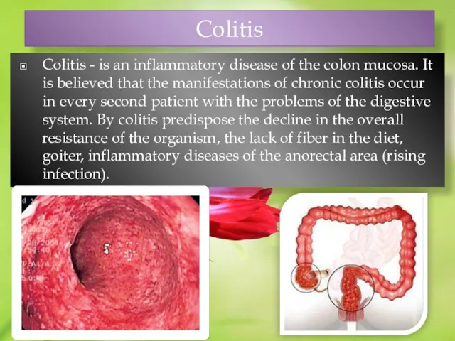 Сolitis Сolitis - is an inflammatory disease of the colon mucosa. It is