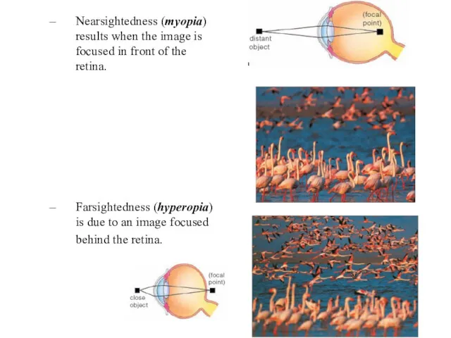 Nearsightedness (myopia) results when the image is focused in front of the retina.