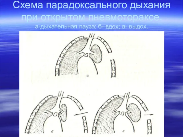 Схема парадоксального дыхания при открытом пневмотораксе. а-дыхательная пауза; б- вдох; в- выдох.