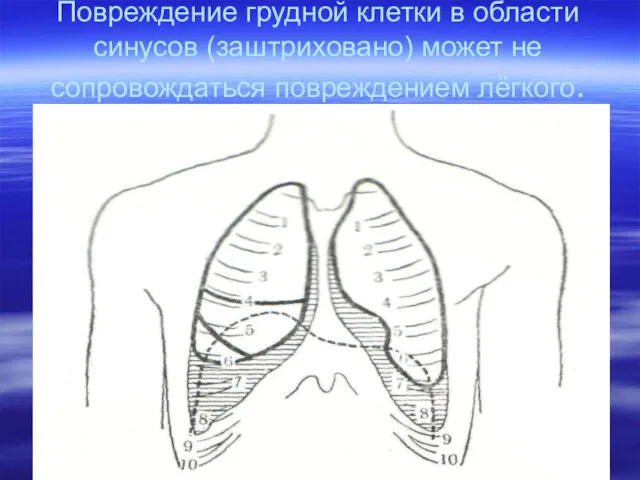 Повреждение грудной клетки в области синусов (заштриховано) может не сопровождаться повреждением лёгкого.