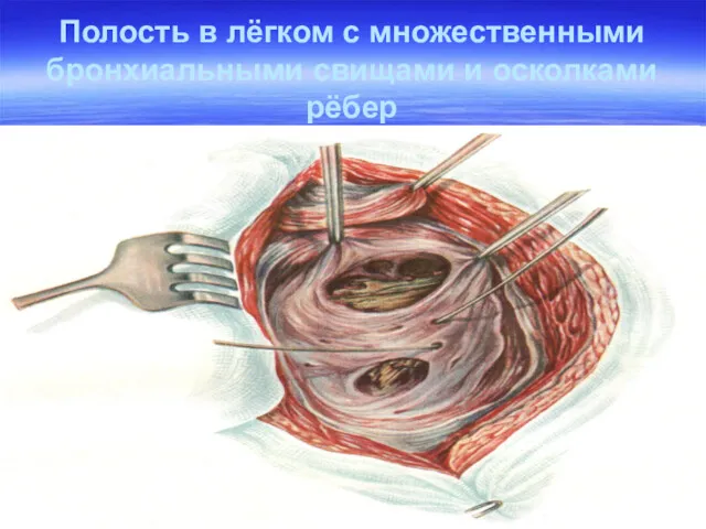 Полость в лёгком с множественными бронхиальными свищами и осколками рёбер