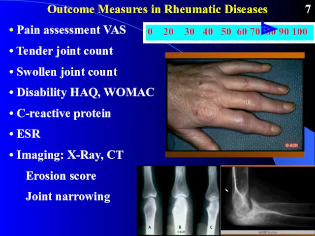 Outcome Measures in Rheumatic Diseases Pain assessment VAS Tender joint count Swollen joint