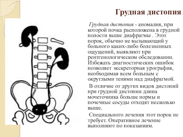 Грудная дистопия Грудная дистопия - аномалия, при которой почка расположена