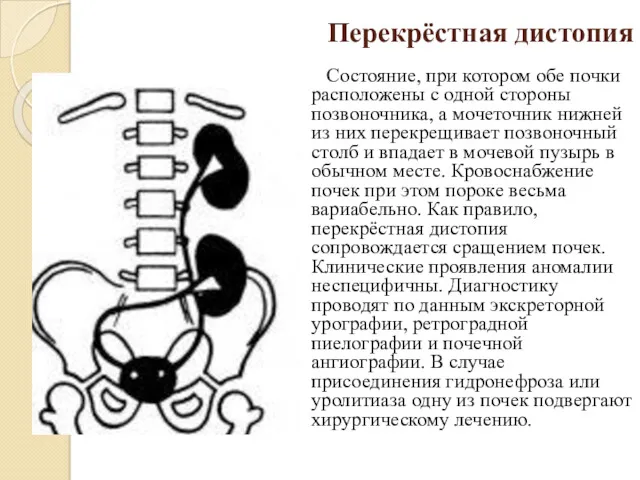 Перекрёстная дистопия Состояние, при котором обе почки расположены с одной