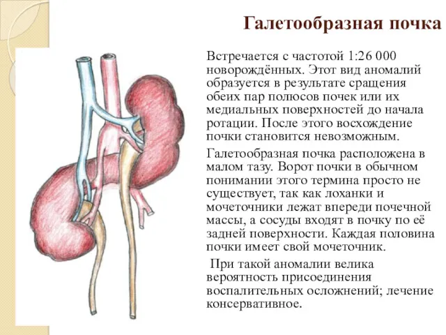 Галетообразная почка Встречается с частотой 1:26 000 новорождённых. Этот вид