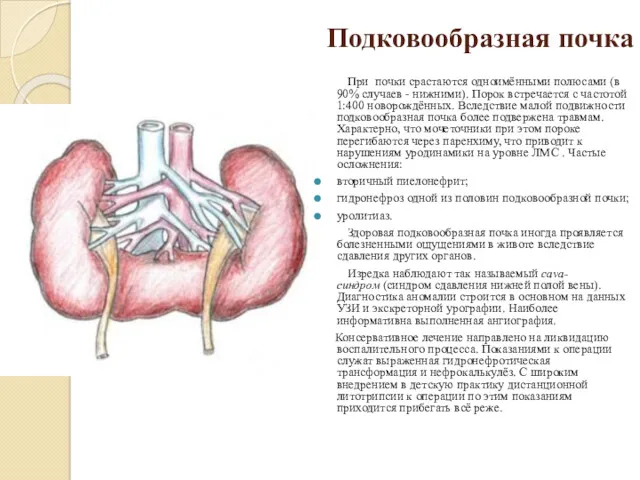 Подковообразная почка При почки срастаются одноимёнными полюсами (в 90% случаев