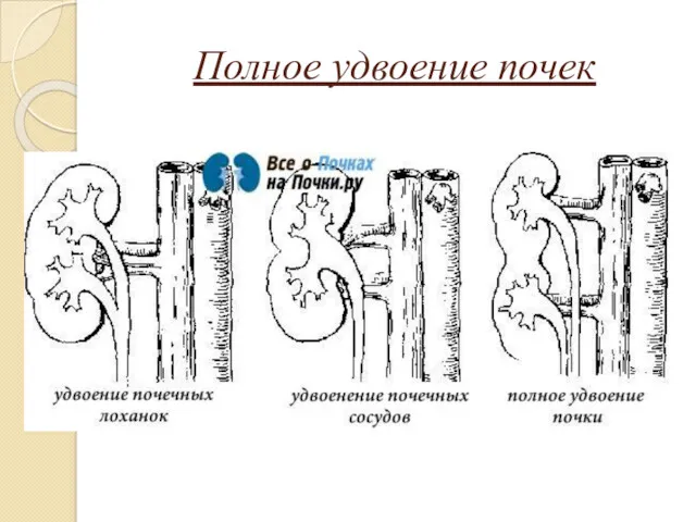 Полное удвоение почек