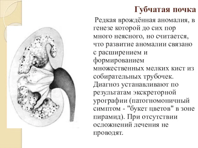 Губчатая почка Редкая врождённая аномалия, в генезе которой до сих