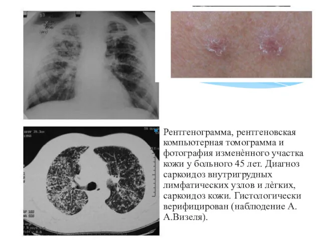 Рентгенограмма, рентгеновская компьютерная томограмма и фотография изменѐнного участка кожи у