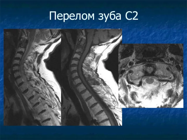 Перелом зуба С2