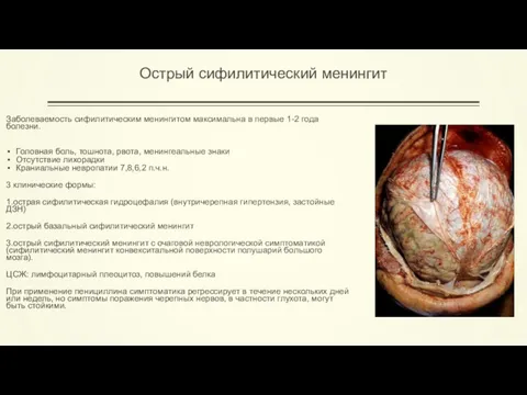Острый сифилитический менингит Заболеваемость сифилитическим менингитом максимальна в первые 1-2