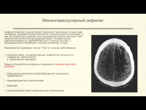 Менинговаскулярный сифилис Сифилитический эндоартериит вовлекает мозговые сосуды всех калибров, вызывая