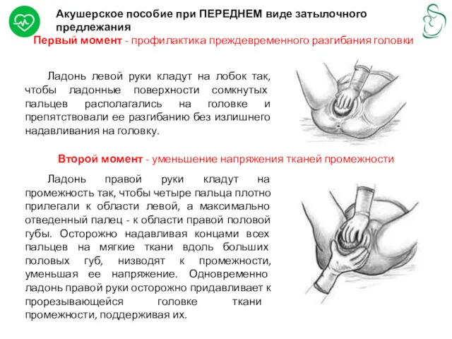 Акушерское пособие при ПЕРЕДНЕМ виде затылочного предлежания Первый момент -