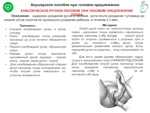 Акушерское пособие при тазовом предлежании КЛАССИЧЕСКОЕ РУЧНОЕ ПОСОБИЕ ПРИ ТАЗОВОМ