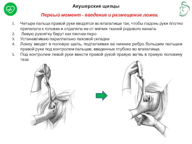 Акушерские щипцы Первый момент - введение и размещение ложек. Четыре