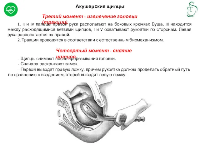 Акушерские щипцы Третий момент - извлечение головки (тракции). 1. II