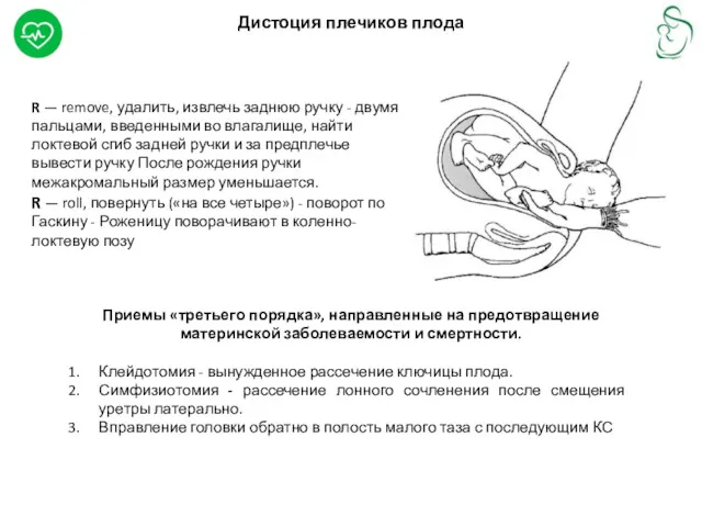 Дистоция плечиков плода R — remove, удалить, извлечь заднюю ручку