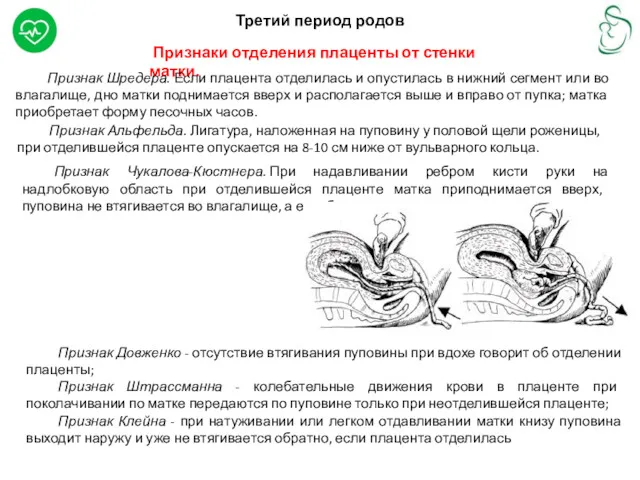 Третий период родов Признаки отделения плаценты от стенки матки. Признак