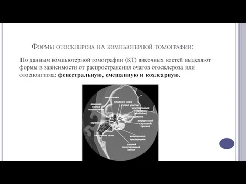 Формы отосклероза на компьютерной томографии: По данным компьютерной томографии (КТ)