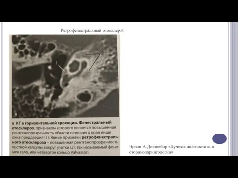 Ретрофенестральный отосклероз Эрвин А.Дюннебир «Лучевая диагностика в оториноларингологии»