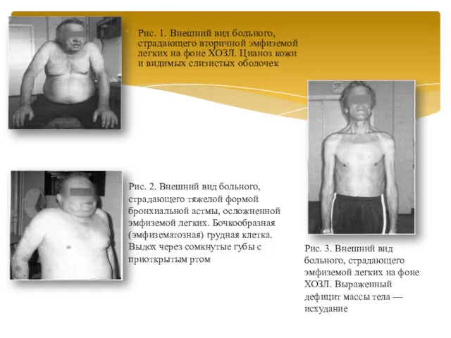 Рис. 1. Внешний вид больного, страдающего вторичной эмфиземой легких на