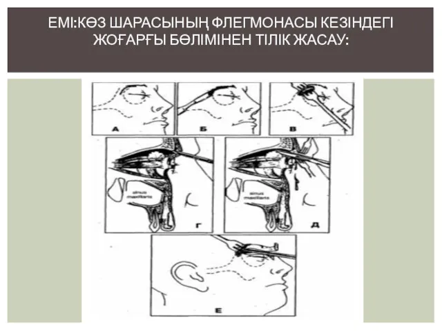 ЕМІ:КӨЗ ШАРАСЫНЫҢ ФЛЕГМОНАСЫ КЕЗІНДЕГІ ЖОҒАРҒЫ БӨЛІМІНЕН ТІЛІК ЖАСАУ: