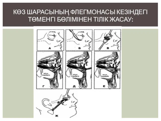 КӨЗ ШАРАСЫНЫҢ ФЛЕГМОНАСЫ КЕЗІНДЕГІ ТӨМЕНГІ БӨЛІМІНЕН ТІЛІК ЖАСАУ: