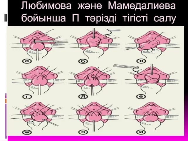 Любимова және Мамедалиева бойынша П тәрізді тігісті салу