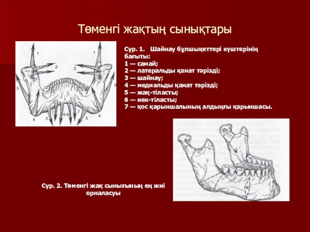 Төменгі жақтың сынықтары Сур. 2. Төменгі жақ сынығының ең жиі