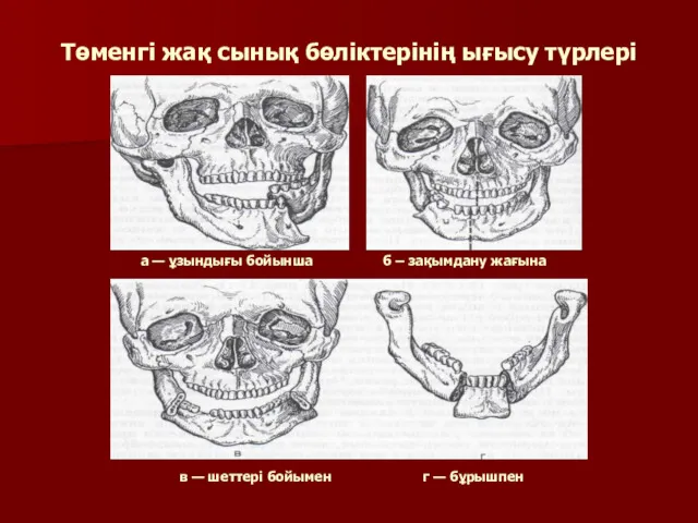 Төменгі жақ сынық бөліктерінің ығысу түрлері в — шеттері бойымен