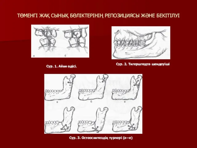 ТӨМЕНГІ ЖАҚ СЫНЫҚ БӨЛІКТЕРІНІҢ РЕПОЗИЦИЯСЫ ЖӘНЕ БЕКІТІЛУІ Сур. 1. Айви