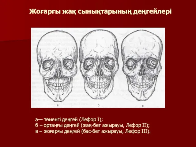 Жоғарғы жақ сынықтарының деңгейлері а— төменгі деңгей (Лефор І); б