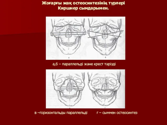 Жоғарғы жақ остеосинтезінің түрлері Киршнер сымдарымен. а,б – параллельді және