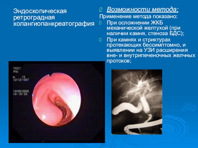 Эндоскопическая ретроградная холангиопанкреатография Возможности метода: Применение метода показано: При осложнении