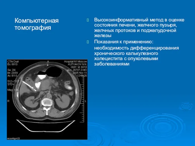 Компьютерная томография Высокоинформативный метод в оценке состояния печени, желчного пузыря,