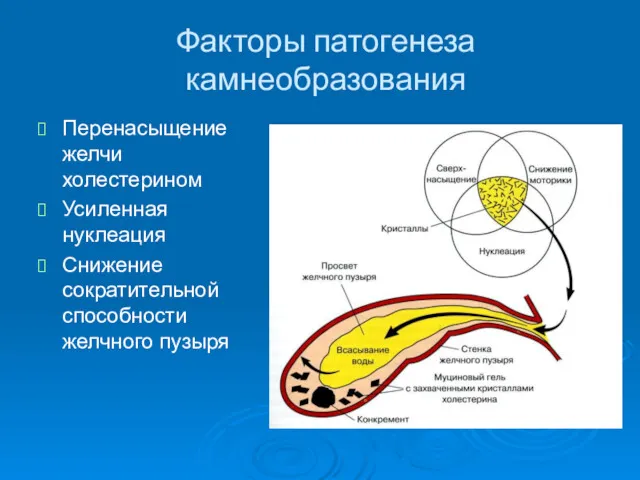 Факторы патогенеза камнеобразования Перенасыщение желчи холестерином Усиленная нуклеация Снижение сократительной способности желчного пузыря