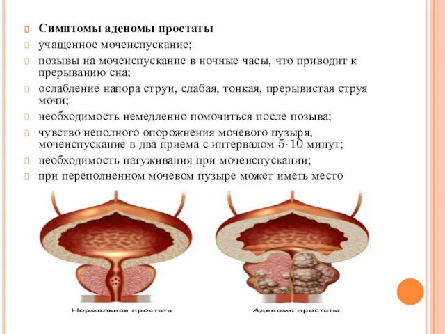 Симптомы аденомы простаты учащенное мочеиспускание; позывы на мочеиспускание в ночные